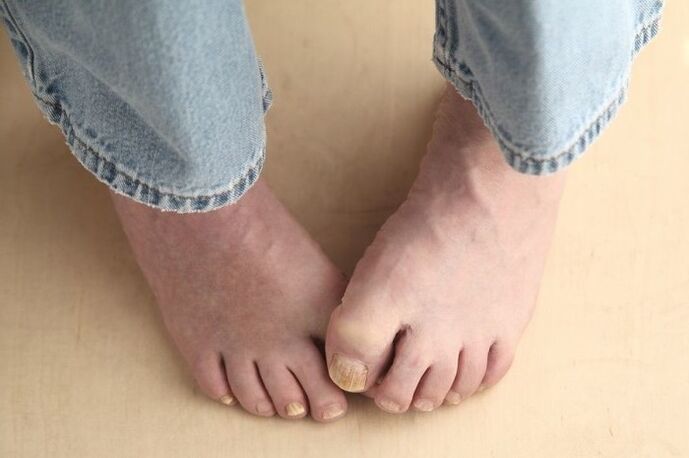 Πόδια με μυκητιακά νύχια