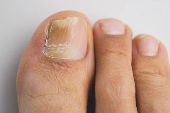 Πώς λειτουργεί το ξύδι στους μύκητες;