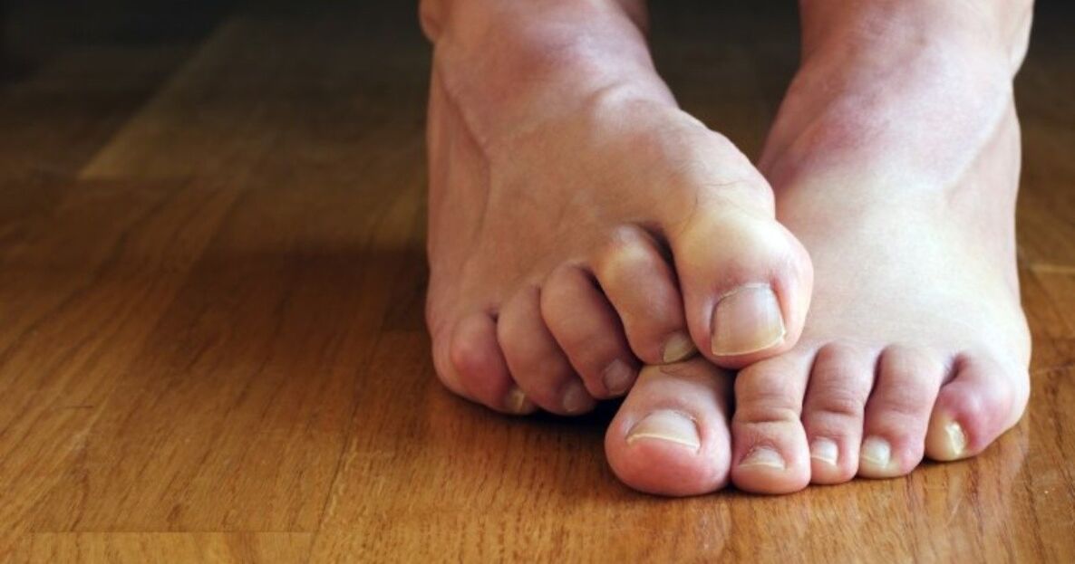 Συμπτώματα ενός μύκητα ανάμεσα στα δάχτυλα των ποδιών